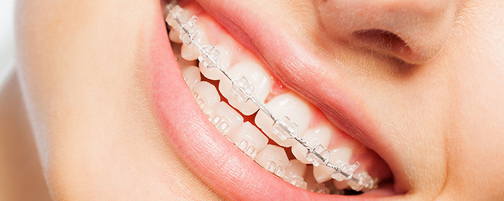 When Should You Choose Clear Braces Over Traditional Braces?