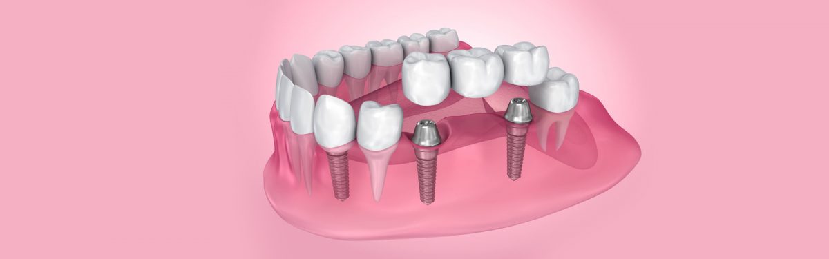 Dental Bridges Vs. Dental Implants: Which one is Better?
