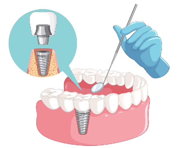Dental Implant Explanation