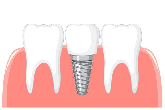 Implant dentist near you