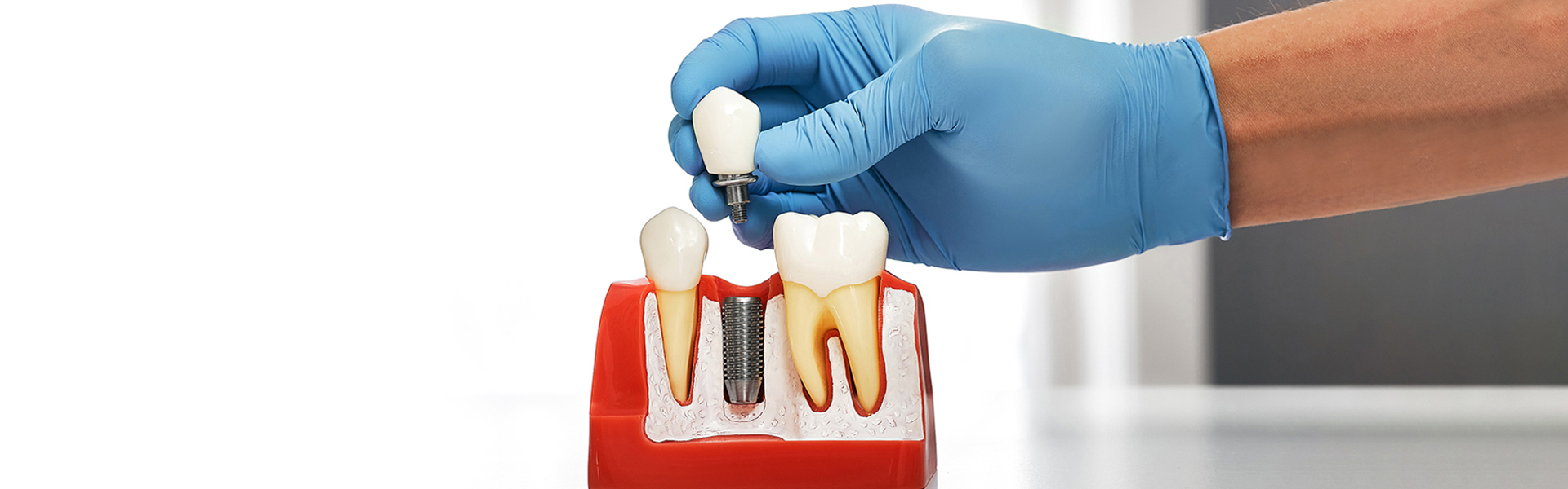 Dental Implants in Houston: A Complete Guide with Dr. Gibson