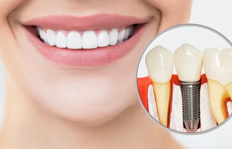 Bone-Grafting-for-Dental-Implants-Why-It’s-Needed